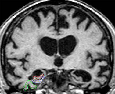 brainmta_figb_989275188.jpg